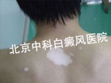白癜风该用什么药